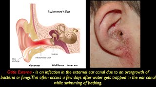 Otitis Externa PEV [upl. by Patrica]